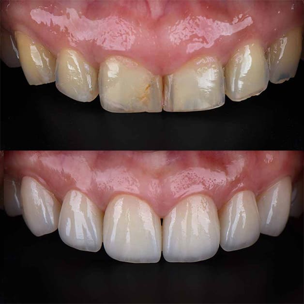 Veneers Zahnschalen