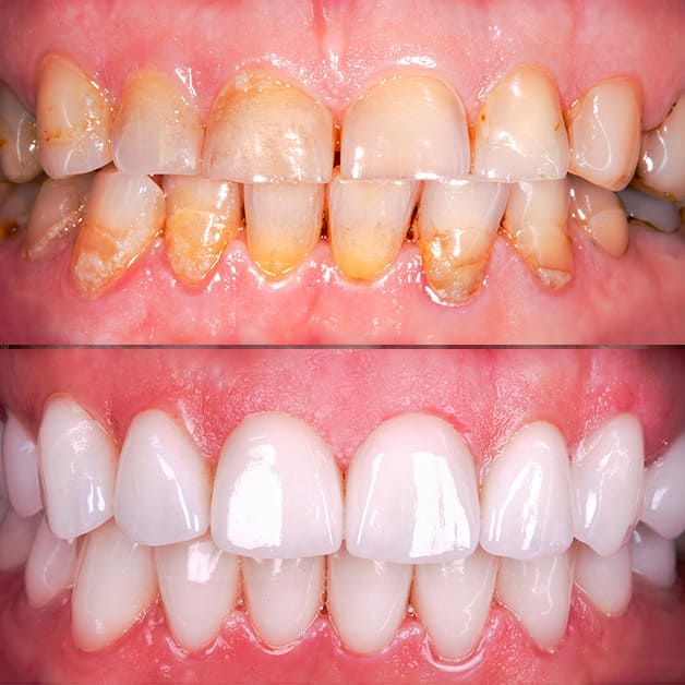 Veneers Zahnschalen